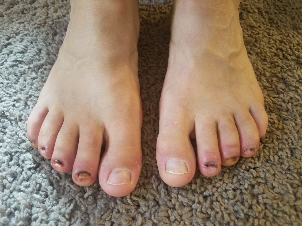 What To Do After Getting An Ingrown Toenail Removed